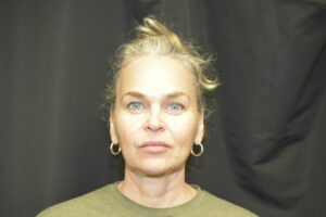 Before Image: In office Naturale face lift Local anesthesia and oral sedation