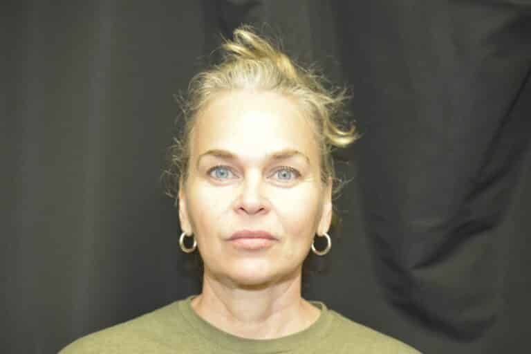 Before Image: In office Naturale face lift Local anesthesia and oral sedation - front