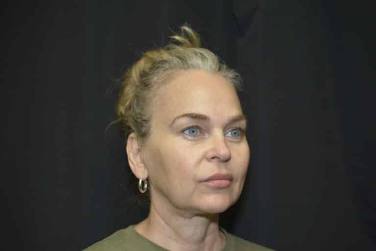 Before Image: In office Naturale face lift Local anesthesia and oral sedation - front
