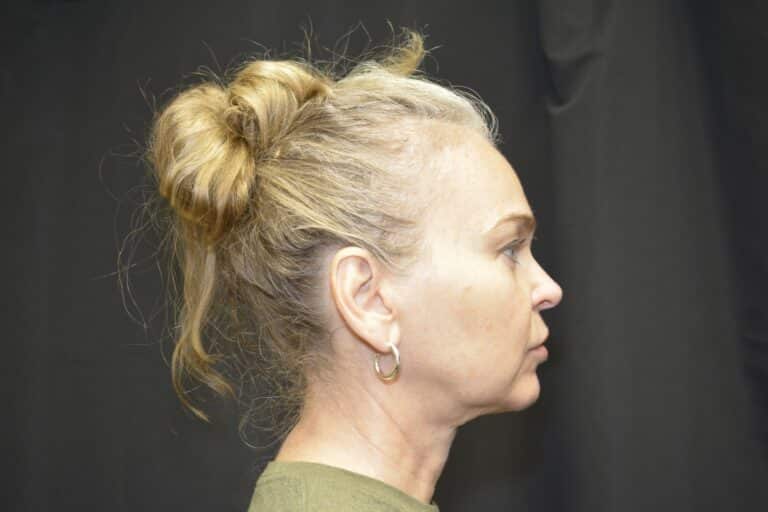 Before Image: In office Naturale face lift Local anesthesia and oral sedation - front