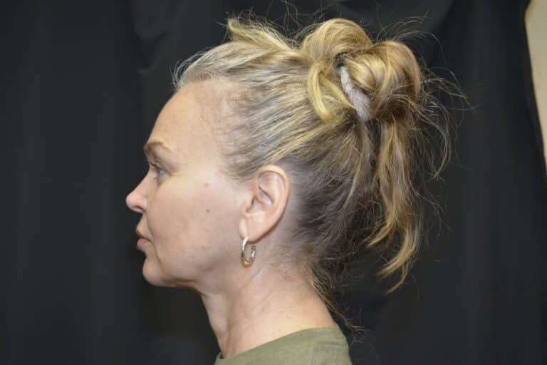 Before Image: In office Naturale face lift Local anesthesia and oral sedation - front