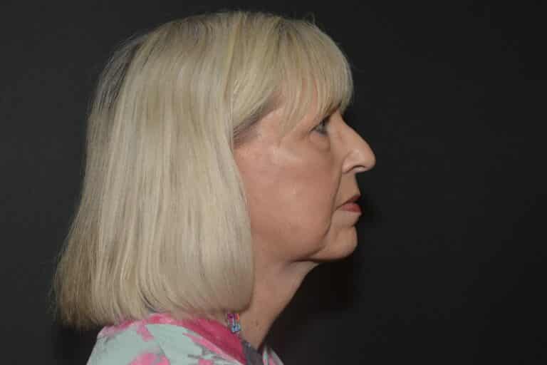 After Image: Naturale Face neck lift In office under Local anesthesia and oral sedation - front