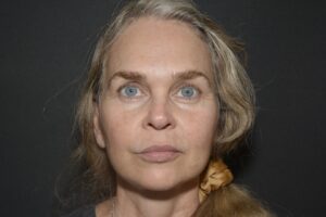 After Image: In office Naturale face lift Local anesthesia and oral sedation