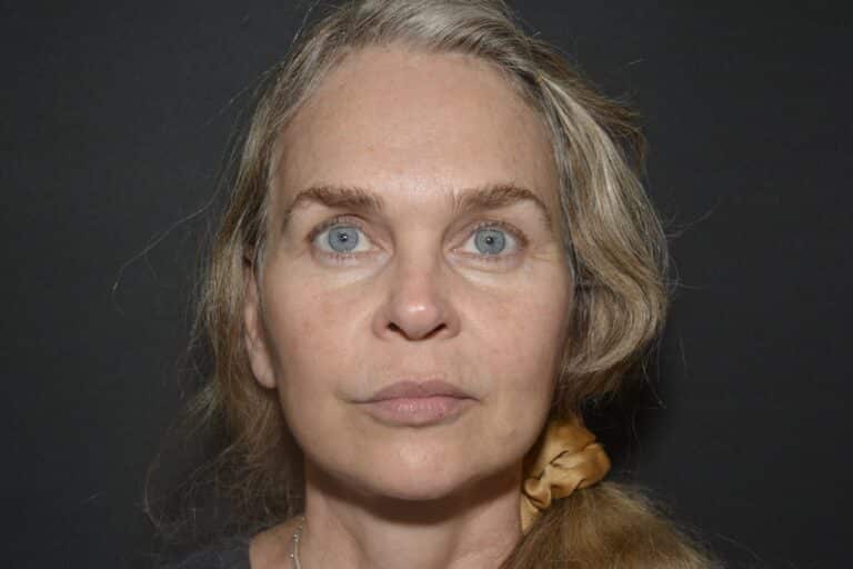 After Image: In office Naturale face lift Local anesthesia and oral sedation - front