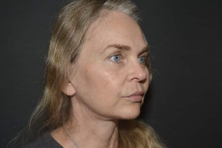 After Image: In office Naturale face lift Local anesthesia and oral sedation - front