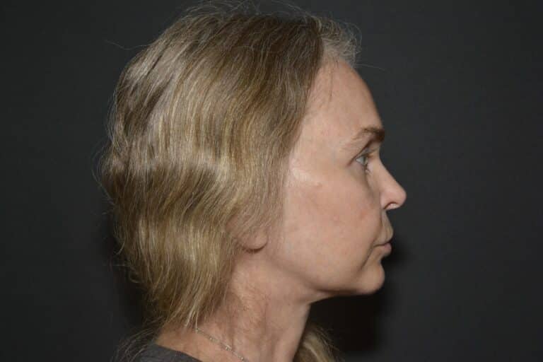 After Image: In office Naturale face lift Local anesthesia and oral sedation - front