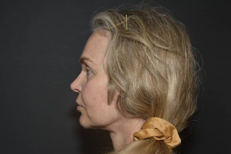 After Image: In office Naturale face lift Local anesthesia and oral sedation - front