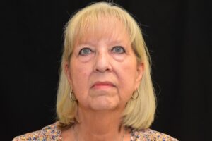 Before Image: Naturale Face neck lift In office under Local anesthesia and oral sedation