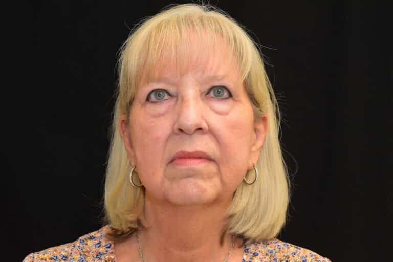 Before Image: Naturale Face neck lift In office under Local anesthesia and oral sedation - front