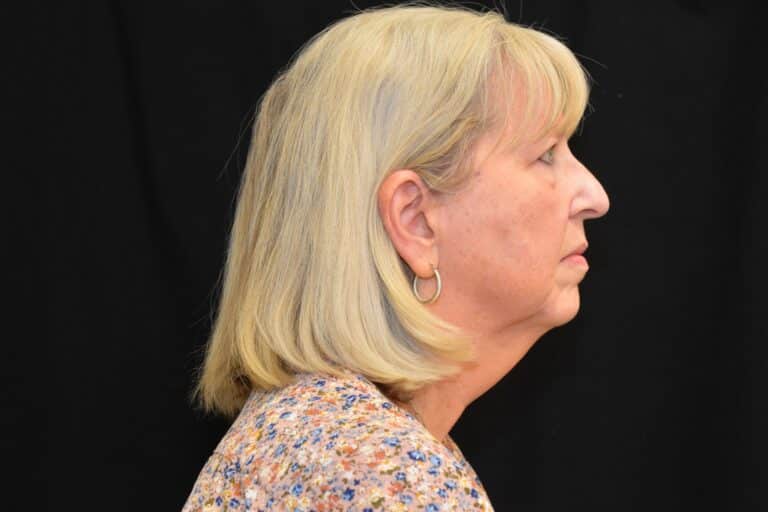 Before Image: Naturale Face neck lift In office under Local anesthesia and oral sedation - front