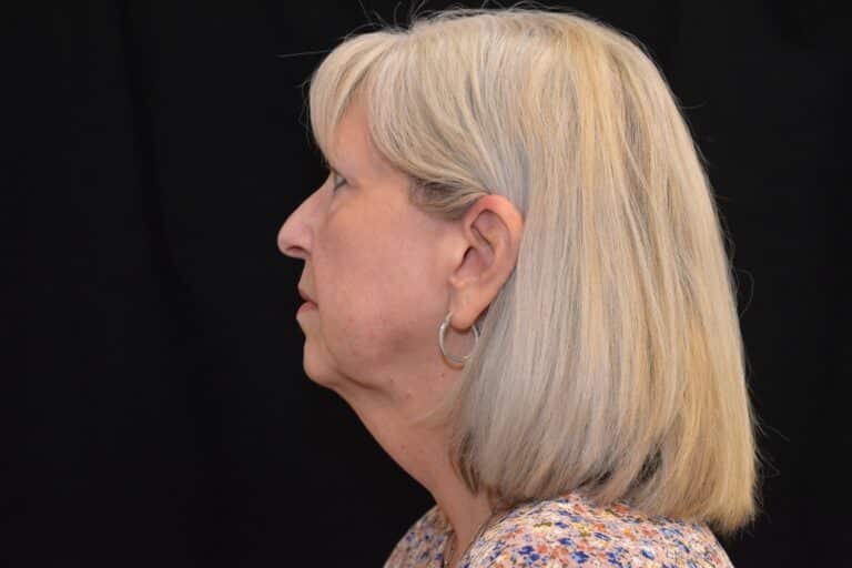 Before Image: Naturale Face neck lift In office under Local anesthesia and oral sedation - front