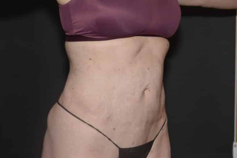 After Image: Liposuction Tummy - 