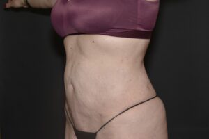 After Image: Liposuction Tummy