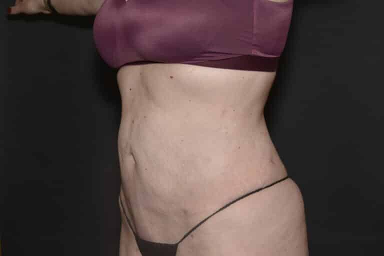 After Image: Liposuction Tummy - front