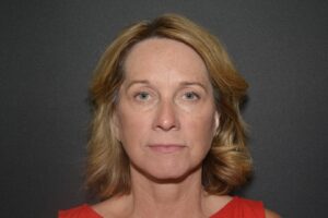 After Image: Naturale face neck lift under Local Anesthesia and Oral Sedation