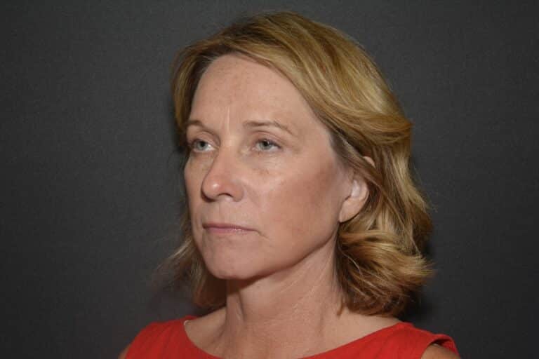 After Image: Naturale face neck lift under Local Anesthesia and Oral Sedation -