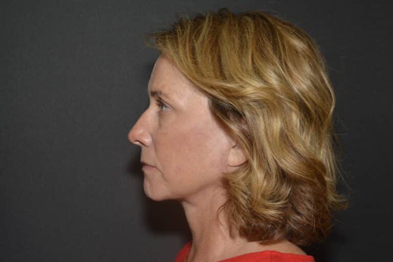 After Image: Naturale face neck lift under Local Anesthesia and Oral Sedation - 