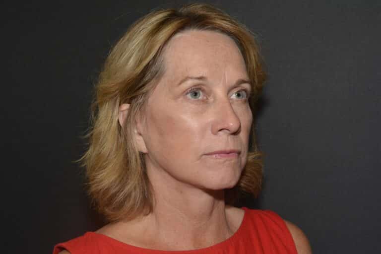 After Image: Naturale face neck lift under Local Anesthesia and Oral Sedation - 