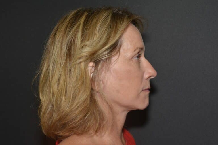 After Image: Naturale face neck lift under Local Anesthesia and Oral Sedation - 