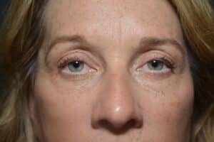 After Image: Upper eyelid surgery only local anesthesia in office