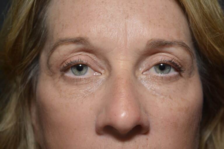 After Image: Upper eyelid surgery only local anesthesia in office - front