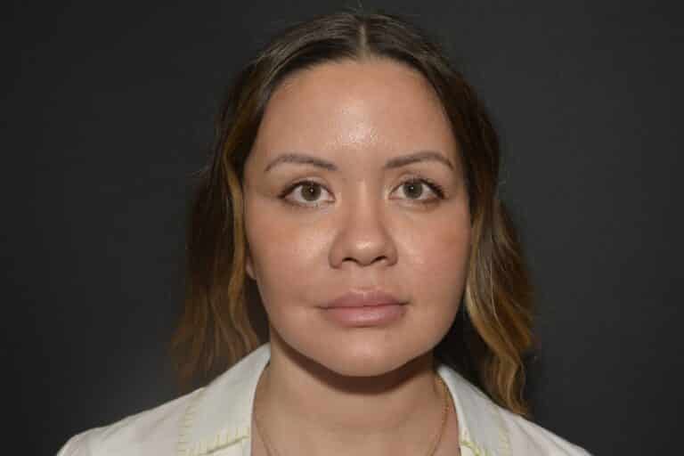 After Image: Naturale face neck lift In office Local Anesthesia and oral sedation - 