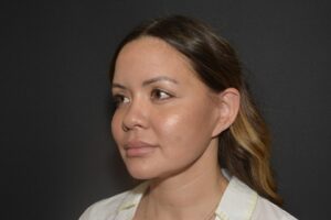 After Image: Naturale face neck lift In office Local Anesthesia and oral sedation