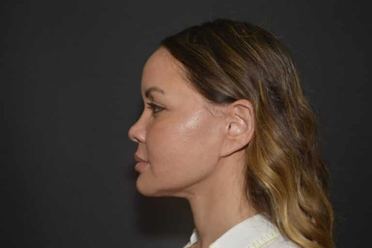 After Image: Naturale face neck lift In office Local Anesthesia and oral sedation - 