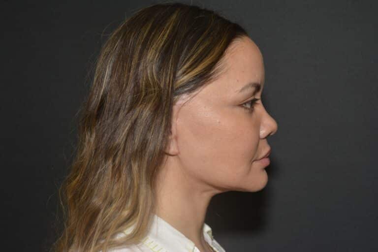 After Image: Naturale face neck lift In office Local Anesthesia and oral sedation -