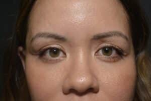 After Image: Upper eyelid surgery (only) Local anesthesia in office
