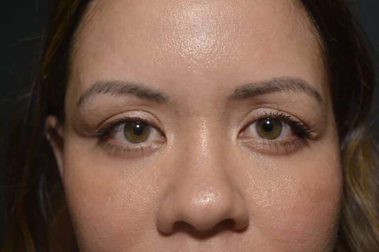 After Image: Upper eyelid surgery (only) Local anesthesia in office - 