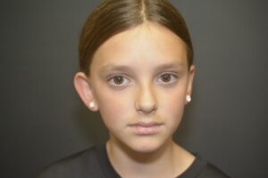 Before Image: Otoplasty Ear reshaping