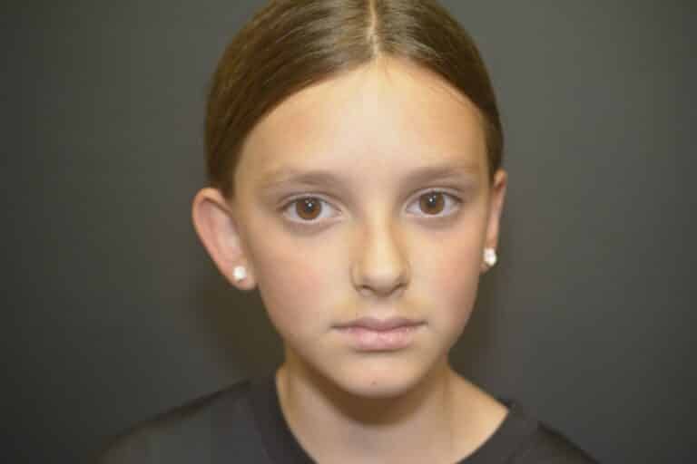 Before Image: Otoplasty Ear reshaping - front