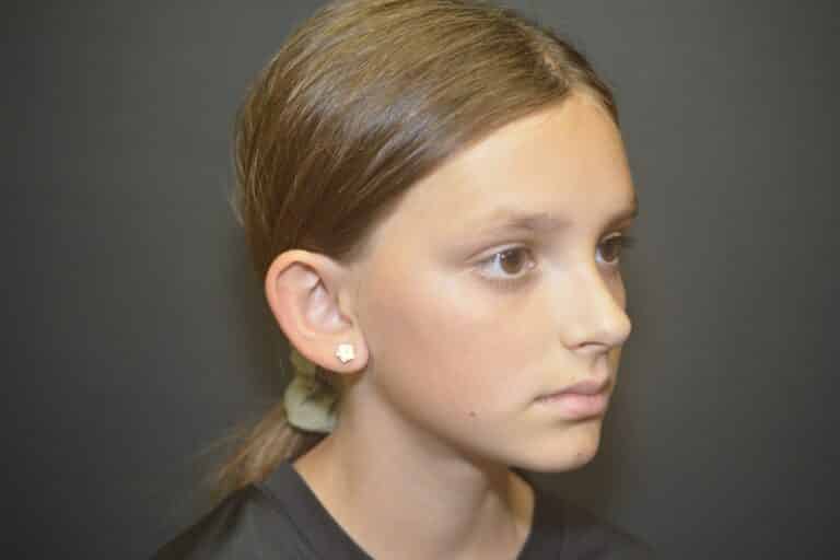 Before Image: Otoplasty Ear reshaping - 