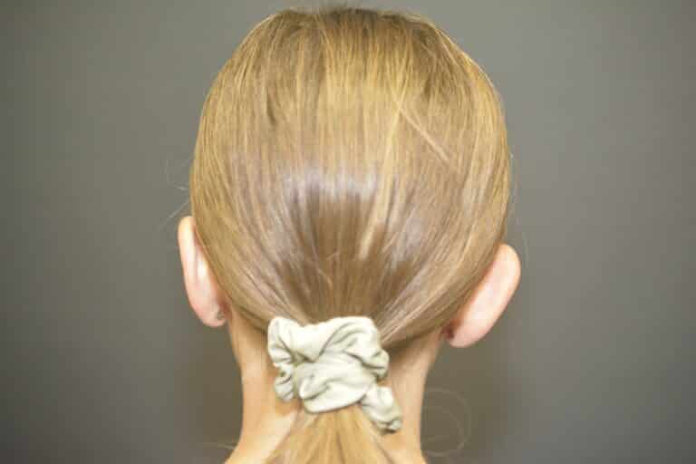 Before Image: Otoplasty Ear reshaping - 