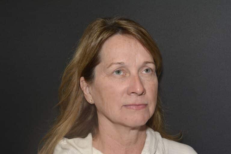 Before Image: Naturale face neck lift under Local Anesthesia and Oral Sedation - 