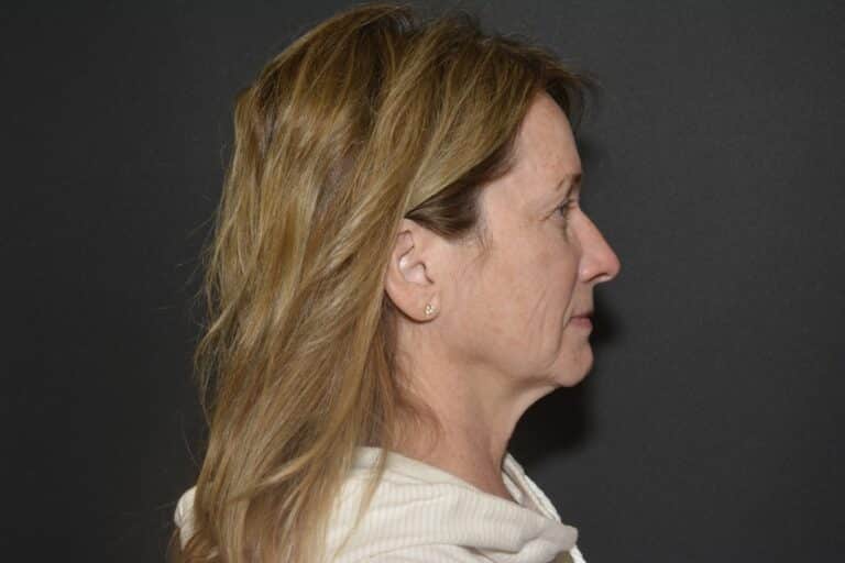 Before Image: Naturale face neck lift under Local Anesthesia and Oral Sedation - 