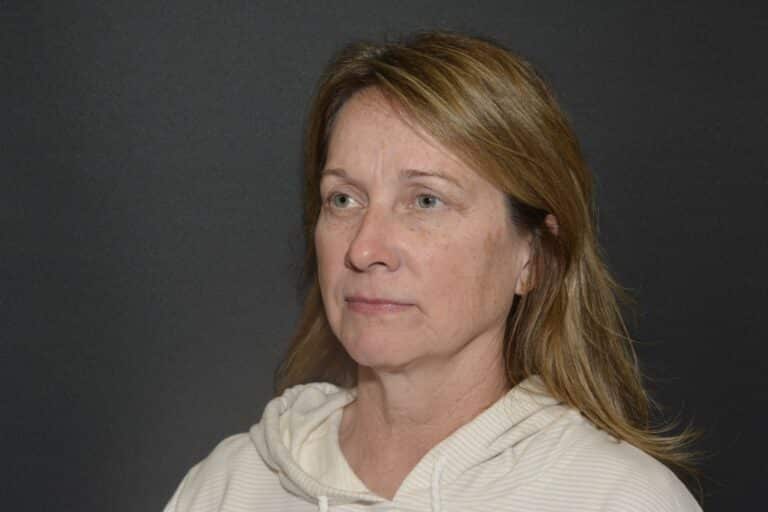 Before Image: Naturale face neck lift under Local Anesthesia and Oral Sedation -