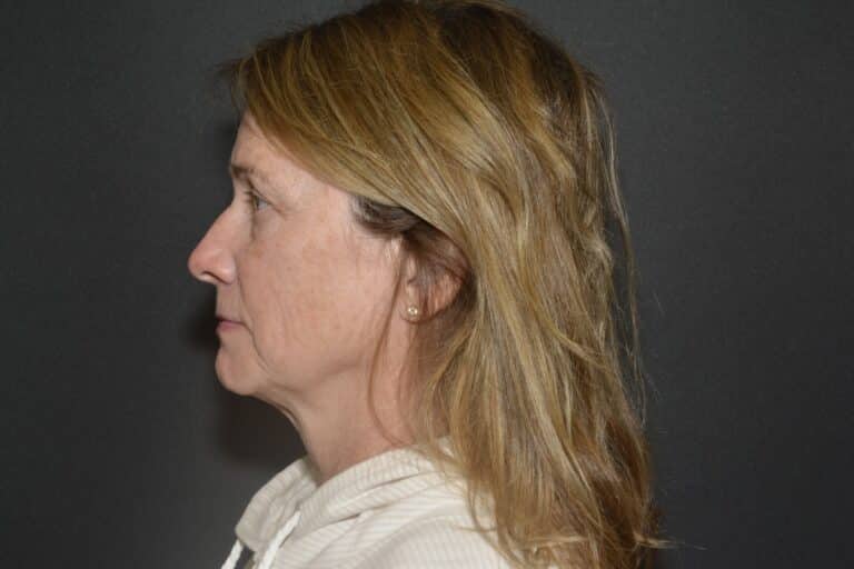 Before Image: Naturale face neck lift under Local Anesthesia and Oral Sedation - 
