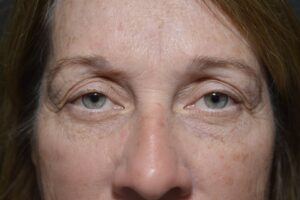 Before Image: Upper eyelid surgery only local anesthesia in office