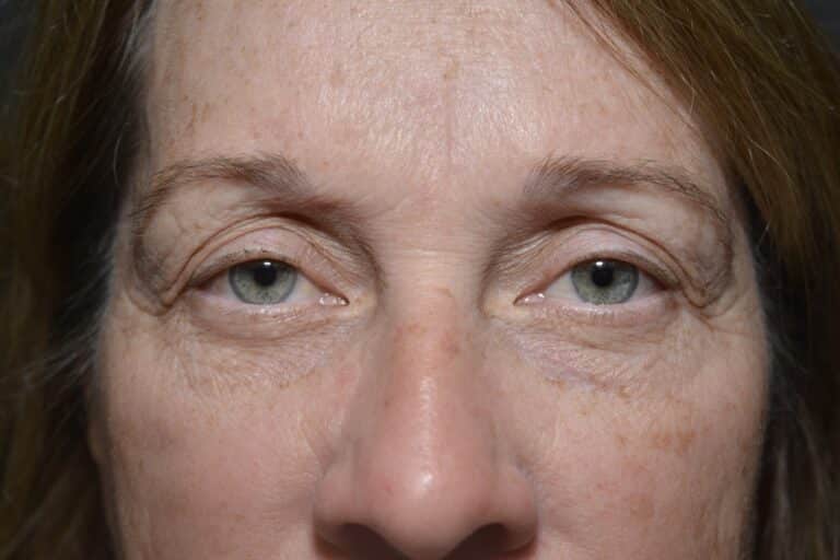 Before Image: Upper eyelid surgery only local anesthesia in office - front
