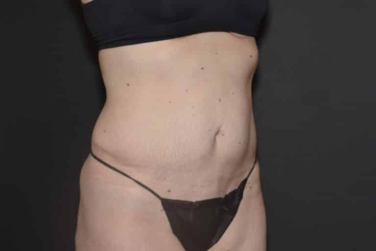 Before Image: Liposuction Tummy - 