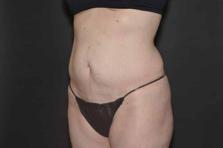 Before Image: Liposuction Tummy - front