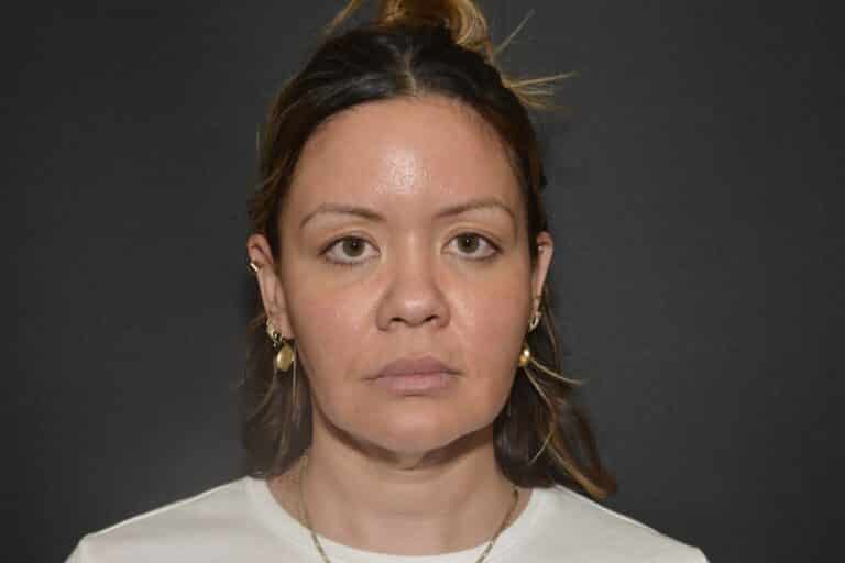 Before Image: Naturale face neck lift In office Local Anesthesia and oral sedation - 