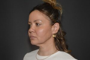 Before Image: Naturale face neck lift In office Local Anesthesia and oral sedation