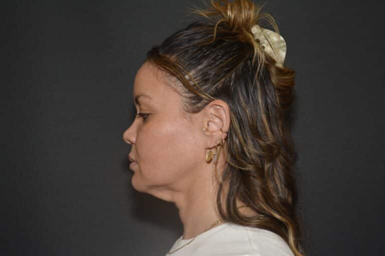 Before Image: Naturale face neck lift In office Local Anesthesia and oral sedation - 