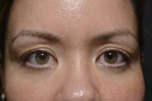Before Image: Upper eyelid surgery (only) Local anesthesia in office