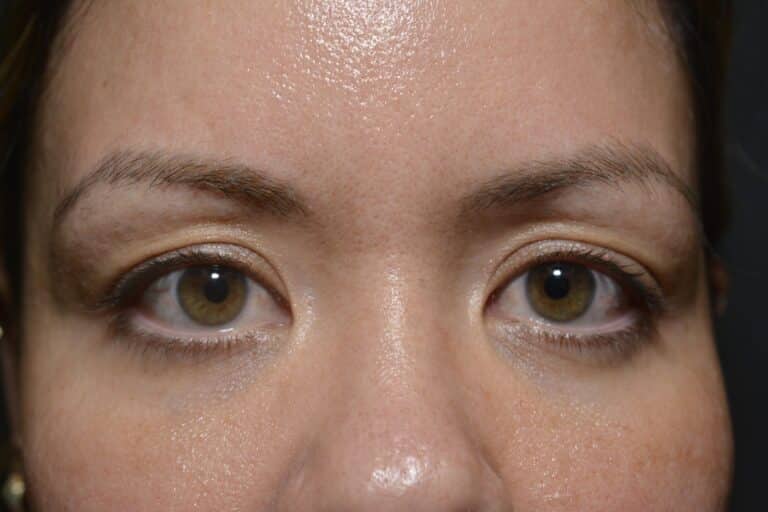 Before Image: Upper eyelid surgery (only) Local anesthesia in office - 
