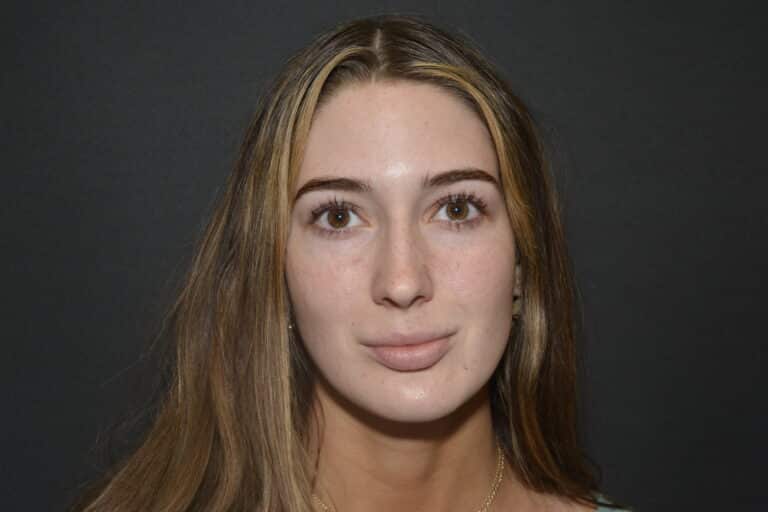 Before Image: FIller to Nose – Liquid rhinoplasty - 