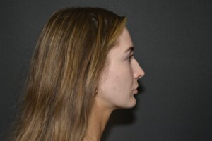 Before Image: FIller to Nose – Liquid rhinoplasty